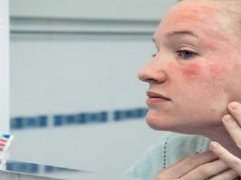 انواع لکه های پوستی و 3 روش پیشگیری و درمان