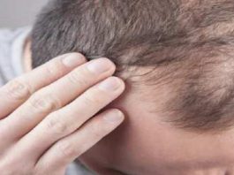 هفت راه درمان برای جلوگیری از ریزش مو در آقایان