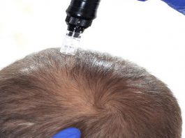 میکرونیدلینگ مو : همه چیز درباره میکرونیدلینگ مو + عوارض و مراحل درمان