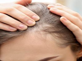 همه چیز درباره ریزش موی هورمونی + 7 درمان مهم