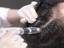 مزوتراپی مو : همه چیز درباره مزوتراپی + انواع عوارض و مراحل درمان