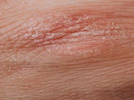 پوست خشک ، 7 نکته کاربردی مراقبت از پوست خشک