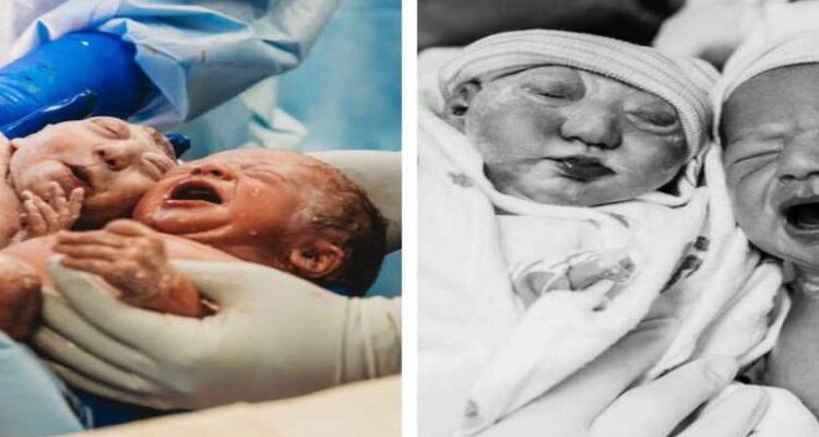 تشکیل نشدن مغز نوزاد یا بیماری آنانسفالی چیست ؟ تشخیص و راه درمان آن