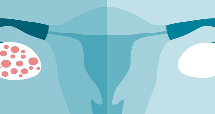 کیست تخمدان یا سندروم تخمدان پلی کیستیک چیست و راه های درمان آن