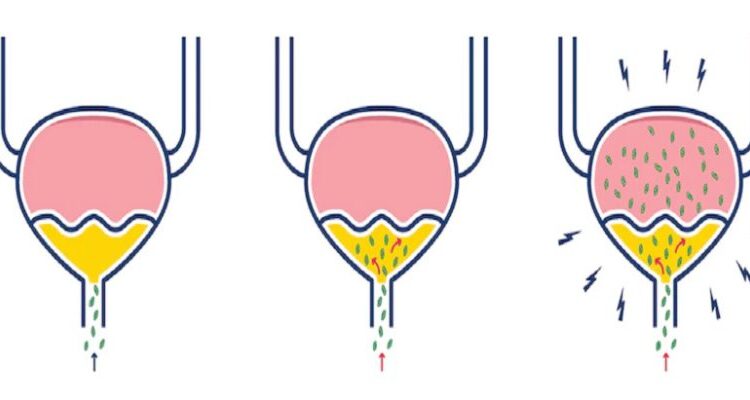 عفونت مثانه چیست و چه علائمی دارد؟