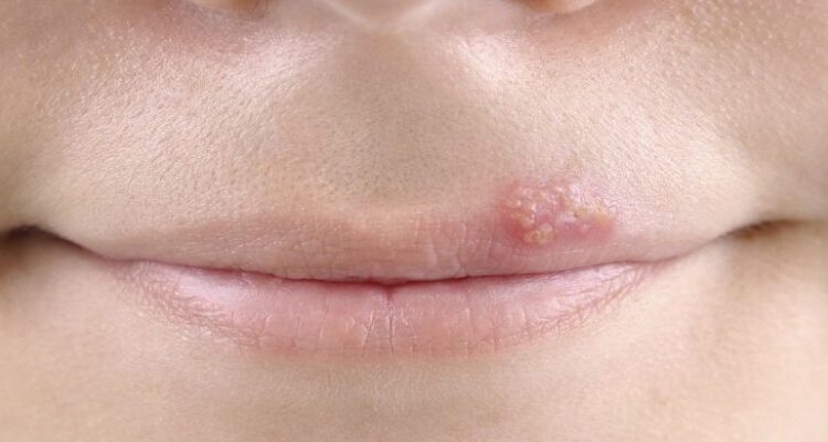 تبخال چیست ؟ علل، علائم و نحوه ی درمان آن