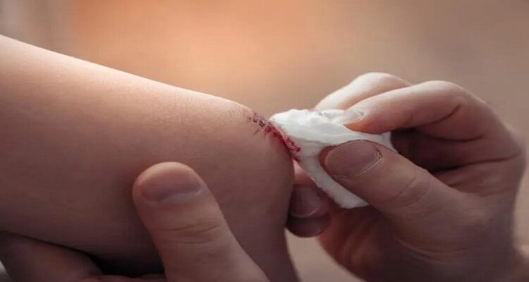 چگونه جلوی خون ریزی را در خانه بگیریم؟