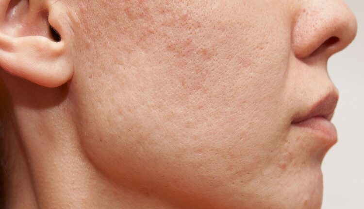 درمان لکه پوستی